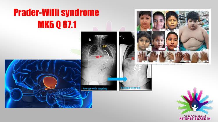 ГИ ЗАПОЗНАВАМЕ РЕТКИТЕ БОЛЕСТИ – ПРАДЕР-ВИЛИ СИНДРОМ