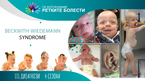 ГИ ЗАПОЗНАВАМЕ РЕТКИТЕ БОЛЕСТИ: БЕКВИТ-ВИДЕМАН СИНДРОМ