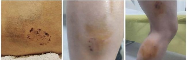 ГЛУТНИЦА КУЧИЊА ИЗГРИЗА УЛТРАМАРАТОНКА НА КЕЈОТ ВО СКОПЈЕ, НА ИНФЕКТИВНА НЕ ДАВААТ ТЕТАНУС АКО НЕ ЛЕЖАТ НА КЛИНИКИТЕ