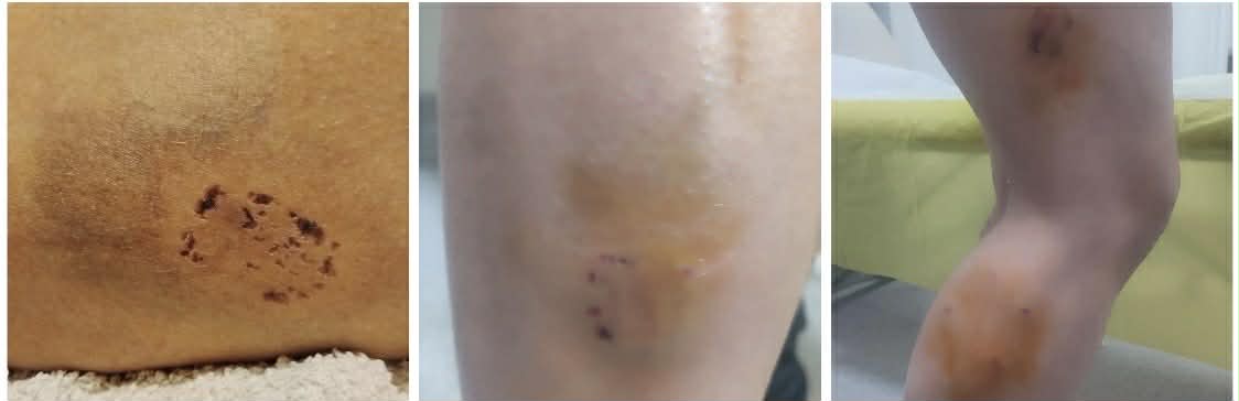 ГЛУТНИЦА КУЧИЊА ИЗГРИЗА УЛТРАМАРАТОНКА НА КЕЈОТ ВО СКОПЈЕ, НА ИНФЕКТИВНА НЕ ДАВААТ ТЕТАНУС АКО НЕ ЛЕЖАТ НА КЛИНИКИТЕ